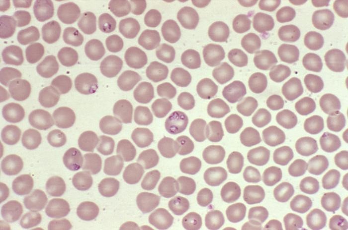 Babesiosis Babesiosis