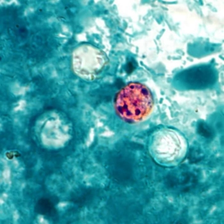 Cyclosporiasis