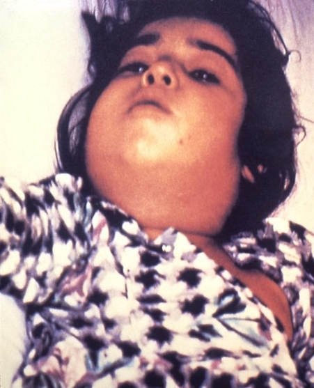Diphtheria Diphtheria