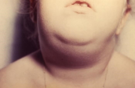 Mumps Mumps