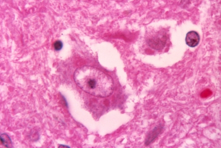 Rabies (Animal, Human) Rabies (Animal, Human)