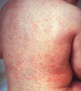 Rubella (German Measles) Rubella (German Measles)