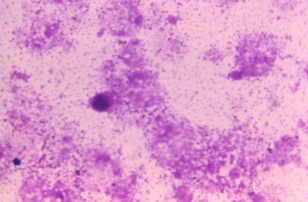 Smallpox