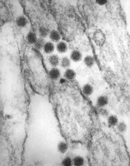 St. Louis Encephalitis